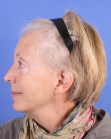 Before Hair Transplant&nbsp;Hair Thinning